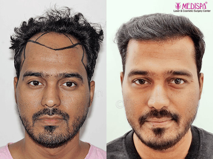 hair transplant rajasthan